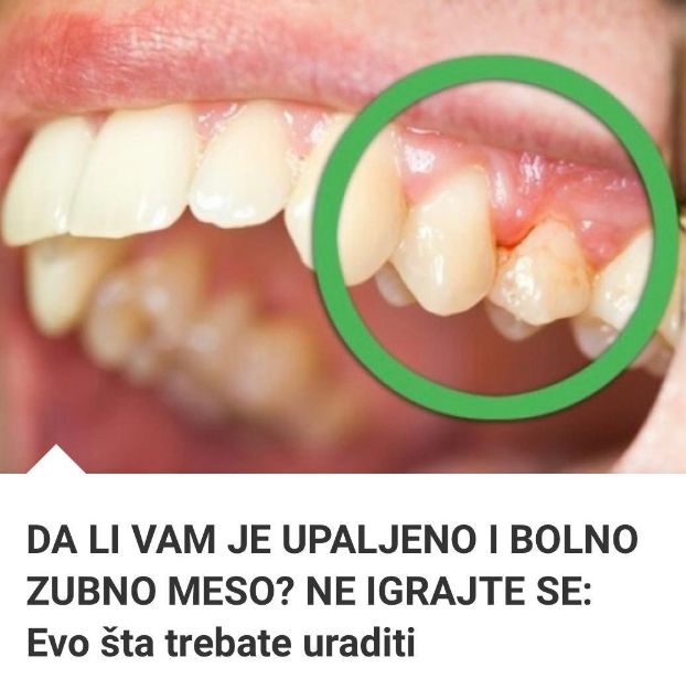 Da Li Vam Je Upaljeno I Bolno Zubno Meso Ne Igrajte Se Evo Ta