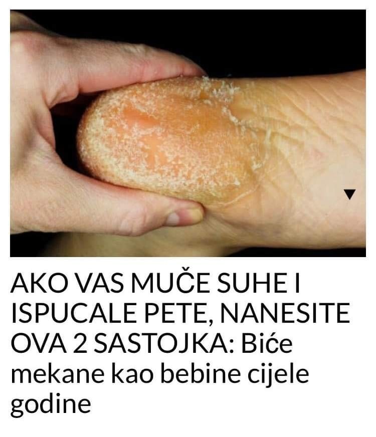 Ako Vas Mu E Suhe I Ispucale Pete Nanesite Znanje Je Mo