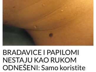 PAPILOMI I BRADAVICE NESTAJU KAO RUKOM ODNEŠENI:  Samo koristite OVO, riješite ih se POTPUNO PRIRODNO