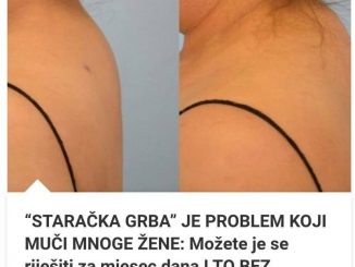 “STARAČKA GRBA” JE PROBLEM KOJI MUČI MNOGE ŽENE:  Možete je se riješiti za mjesec dana I TO BEZ OPERACIJE, VEOMA JEDNOSTAVNO