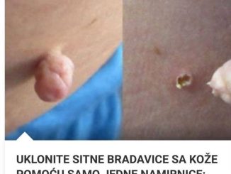 UKLONITE SITNE BRADAVICE SA KOŽE POMOĆU SAMO JEDNE NAMIRNICE:  Ne može jednostavnije!